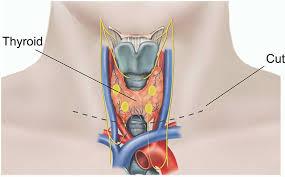 Thyroid Cancer illustration 2