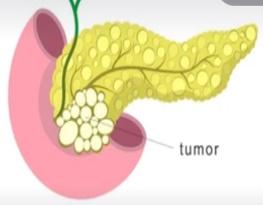 Whipple Procedure illustration 1
